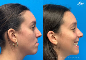 Jaw Surgery Before and After Photo. Surgery performed in Dallas, TX at Law Plastic Surgery.