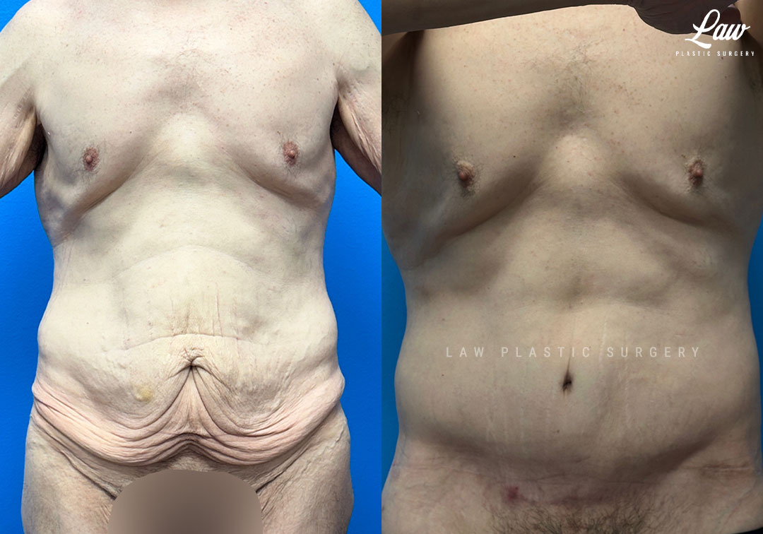 Tummy Tuck (Abdominoplasty) Before and After Photo. Surgery performed in Dallas, TX at Law Plastic Surgery.