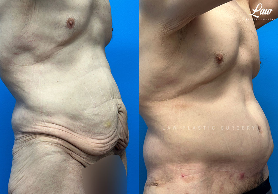 Tummy Tuck (Abdominoplasty) Before and After Photo. Surgery performed in Dallas, TX at Law Plastic Surgery.