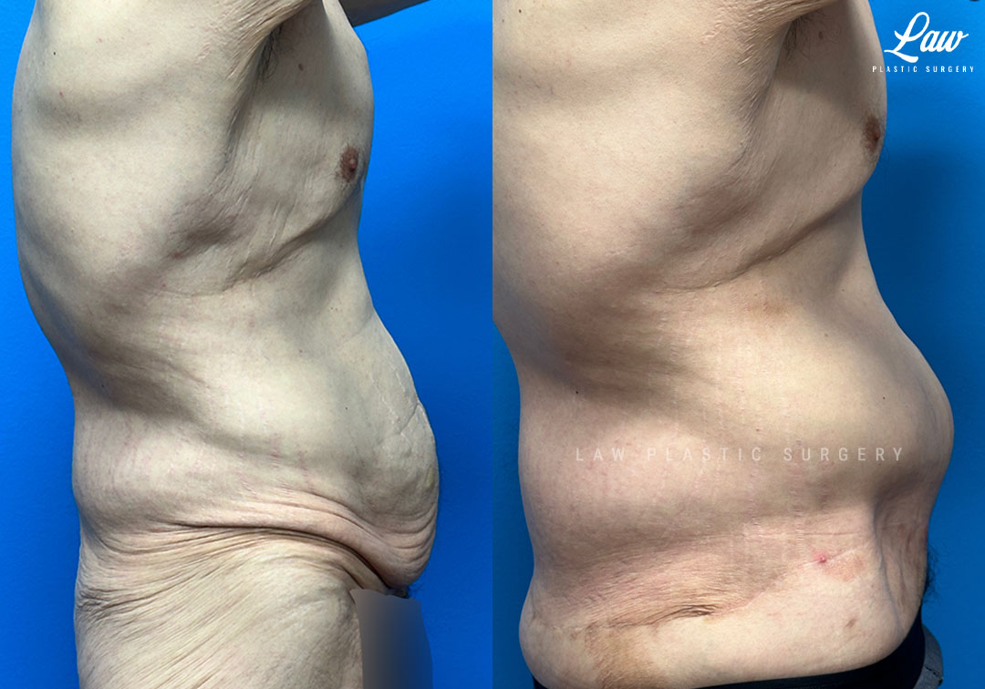 Tummy Tuck (Abdominoplasty) Before and After Photo. Surgery performed in Dallas, TX at Law Plastic Surgery.