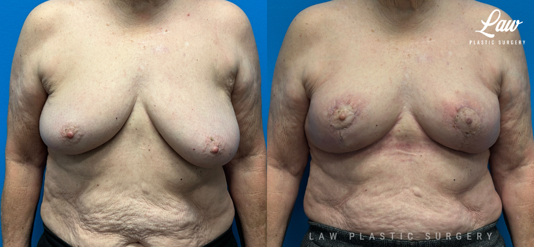 Breast Reconstruction Before and After Photo. Surgery performed in Dallas, TX at Law Plastic Surgery.
