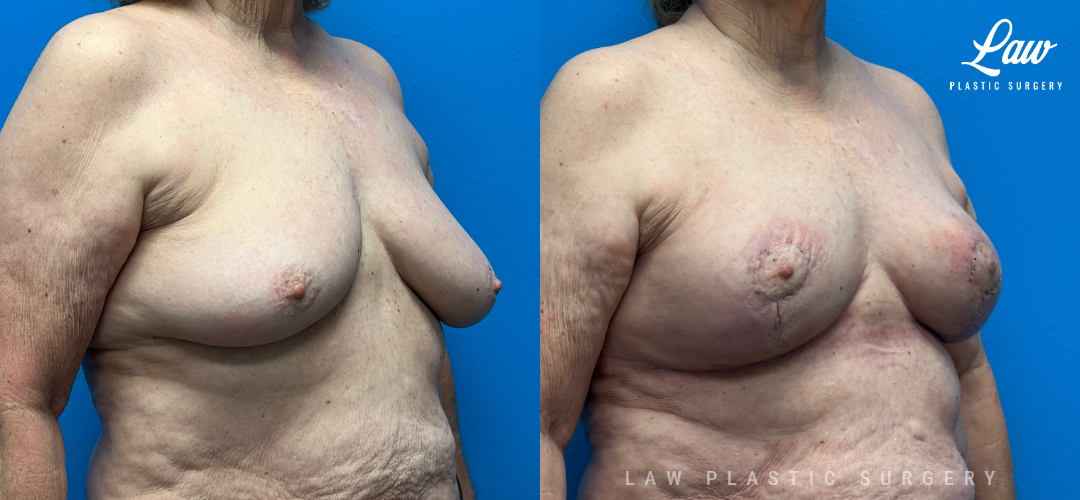 Breast Reconstruction Before and After Photo. Surgery performed in Dallas, TX at Law Plastic Surgery.