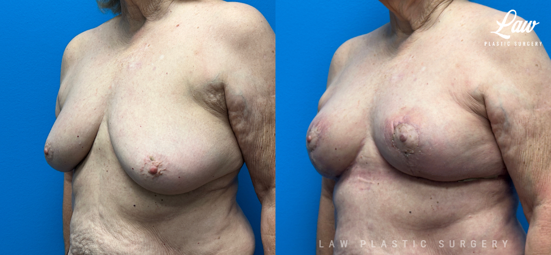 Breast Reconstruction Before and After Photo. Surgery performed in Dallas, TX at Law Plastic Surgery.