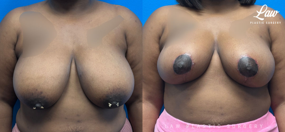 Breast Reduction Before and After Photo. Surgery performed in Dallas, TX at Law Plastic Surgery.