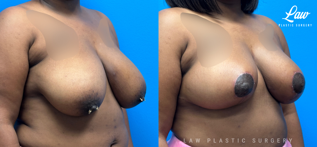 Breast Reduction Before and After Photo. Surgery performed in Dallas, TX at Law Plastic Surgery.