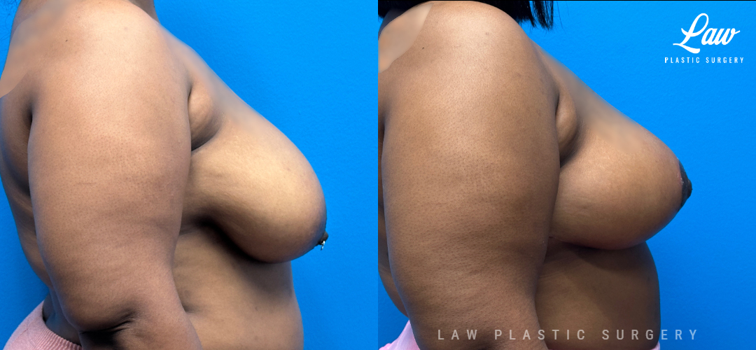 Breast Reduction Before and After Photo. Surgery performed in Dallas, TX at Law Plastic Surgery.