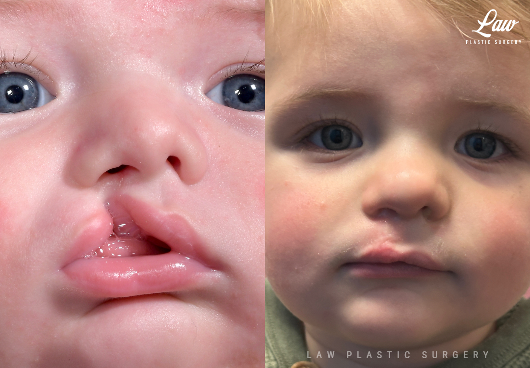 Cleft Lip Repair Before & After Photo. Surgery performed in Dallas, TX at Law Plastic Surgery.