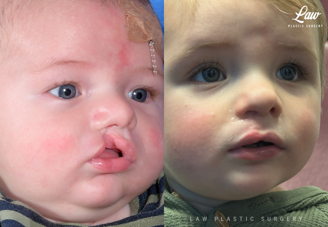 Cleft Lip Repair Before & After Photo. Surgery performed in Dallas, TX at Law Plastic Surgery.