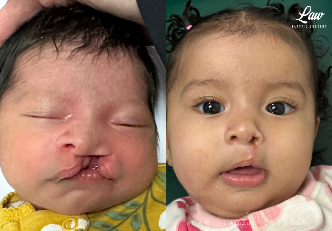 Cleft Lip Repair Before & After Photo. Surgery performed in Dallas, TX at Law Plastic Surgery.