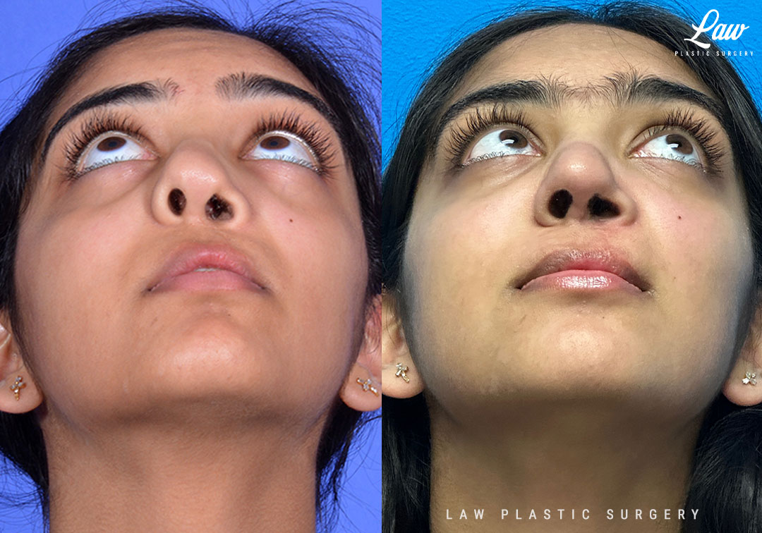 Cleft Rhinoplasty (Cleft Nose Surgery) Before & After Photo. Surgery performed in Dallas, TX at Law Plastic Surgery.