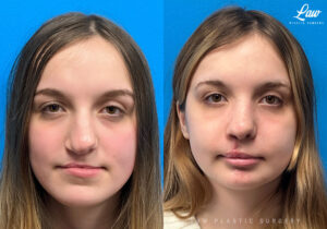 Cleft Rhinoplasty (Cleft Nose Surgery) Before & After Photo. Surgery performed in Dallas, TX at Law Plastic Surgery.
