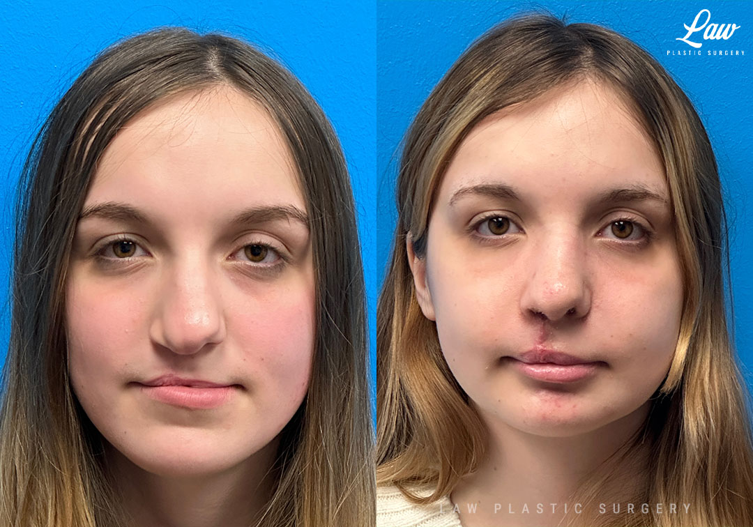 Cleft Rhinoplasty (Cleft Nose Surgery) Before & After Photo. Surgery performed in Dallas, TX at Law Plastic Surgery.