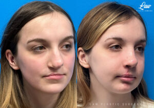 Cleft Rhinoplasty (Cleft Nose Surgery) Before & After Photo. Surgery performed in Dallas, TX at Law Plastic Surgery.