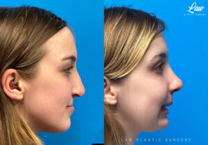 Cleft Rhinoplasty (Cleft Nose Surgery) Before & After Photo. Surgery performed in Dallas, TX at Law Plastic Surgery.