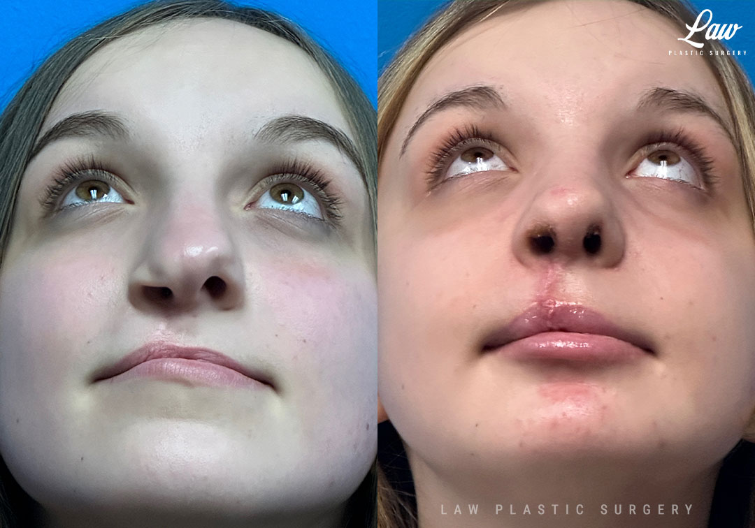 Cleft Rhinoplasty (Cleft Nose Surgery) Before & After Photo. Surgery performed in Dallas, TX at Law Plastic Surgery.