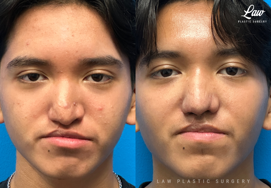 Cleft Rhinoplasty (Cleft Nose Surgery) Before & After Photo. Surgery performed in Dallas, TX at Law Plastic Surgery.