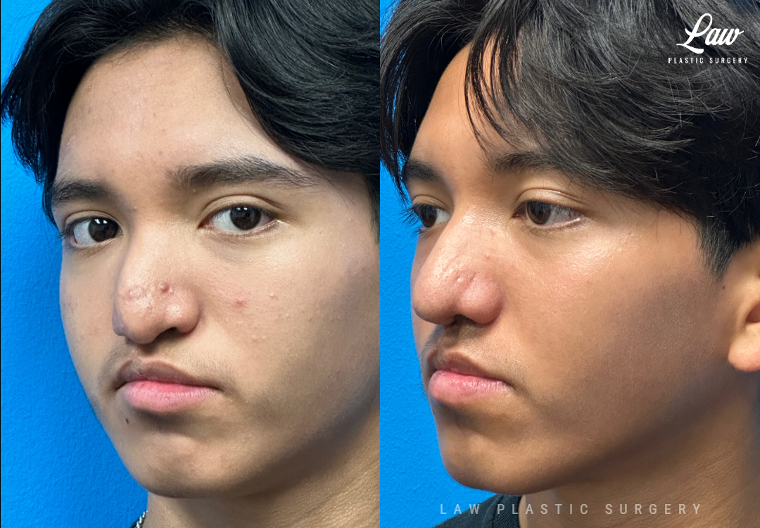 Cleft Rhinoplasty (Cleft Nose Surgery) Before & After Photo. Surgery performed in Dallas, TX at Law Plastic Surgery.