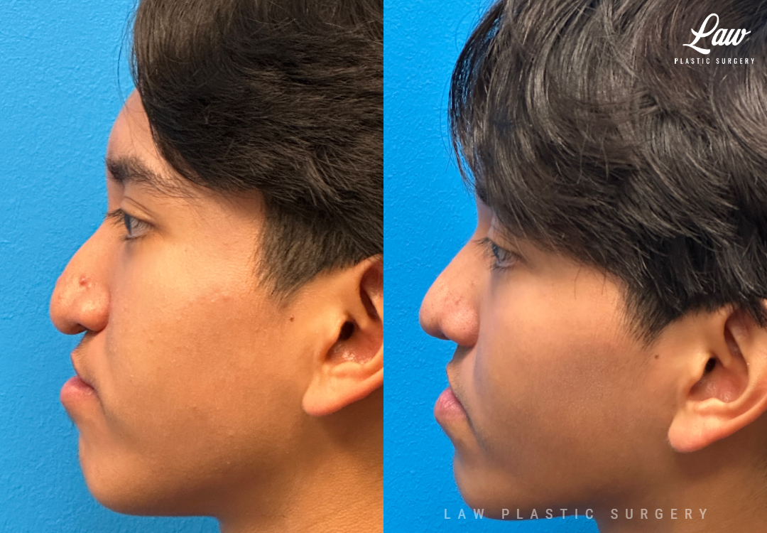 Cleft Rhinoplasty (Cleft Nose Surgery) Before & After Photo. Surgery performed in Dallas, TX at Law Plastic Surgery.