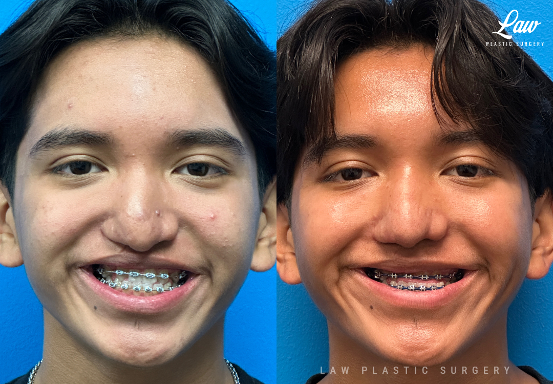 Cleft Rhinoplasty (Cleft Nose Surgery) Before & After Photo. Surgery performed in Dallas, TX at Law Plastic Surgery.