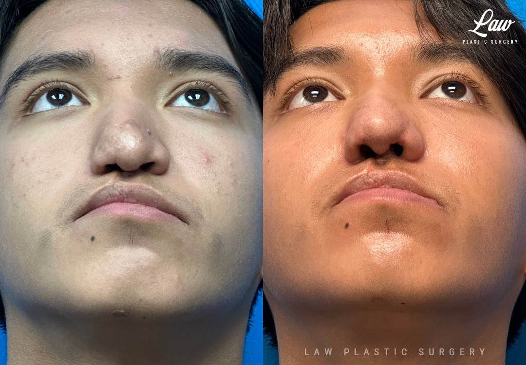Cleft Rhinoplasty (Cleft Nose Surgery) Before & After Photo. Surgery performed in Dallas, TX at Law Plastic Surgery.
