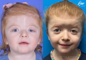 Craniosynostosis Before and After Photo. Surgery performed in Dallas, TX at Law Plastic Surgery.