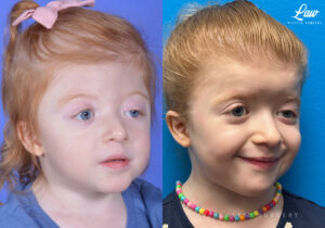 Craniosynostosis Before and After Photo. Surgery performed in Dallas, TX at Law Plastic Surgery.