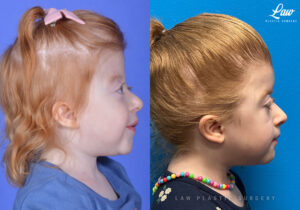 Craniosynostosis Before and After Photo. Surgery performed in Dallas, TX at Law Plastic Surgery.