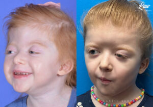 Craniosynostosis Before and After Photo. Surgery performed in Dallas, TX at Law Plastic Surgery.