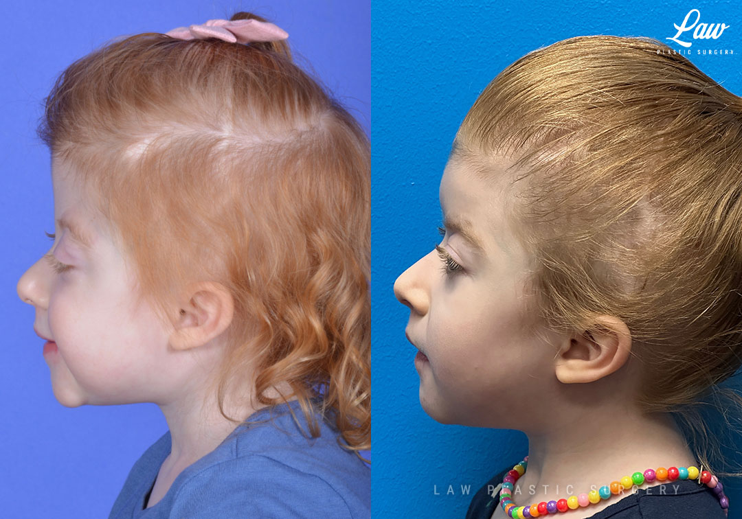 Craniosynostosis Before and After Photo. Surgery performed in Dallas, TX at Law Plastic Surgery.
