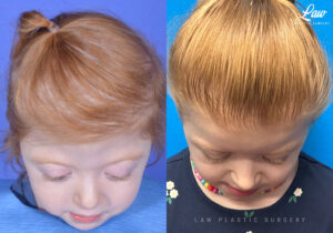 Craniosynostosis Before and After Photo. Surgery performed in Dallas, TX at Law Plastic Surgery.