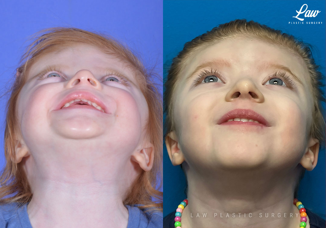Craniosynostosis Before and After Photo. Surgery performed in Dallas, TX at Law Plastic Surgery.