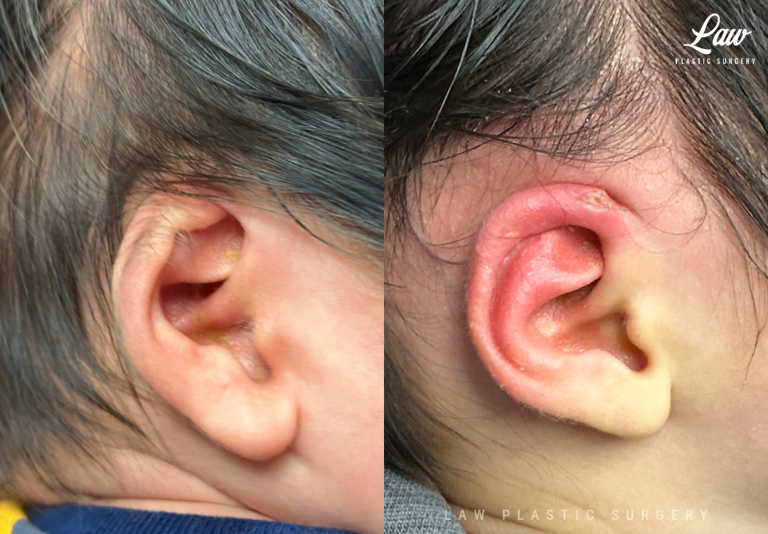 Ear Molding Before and After Photo. Surgery performed in Dallas, TX at Law Plastic Surgery.