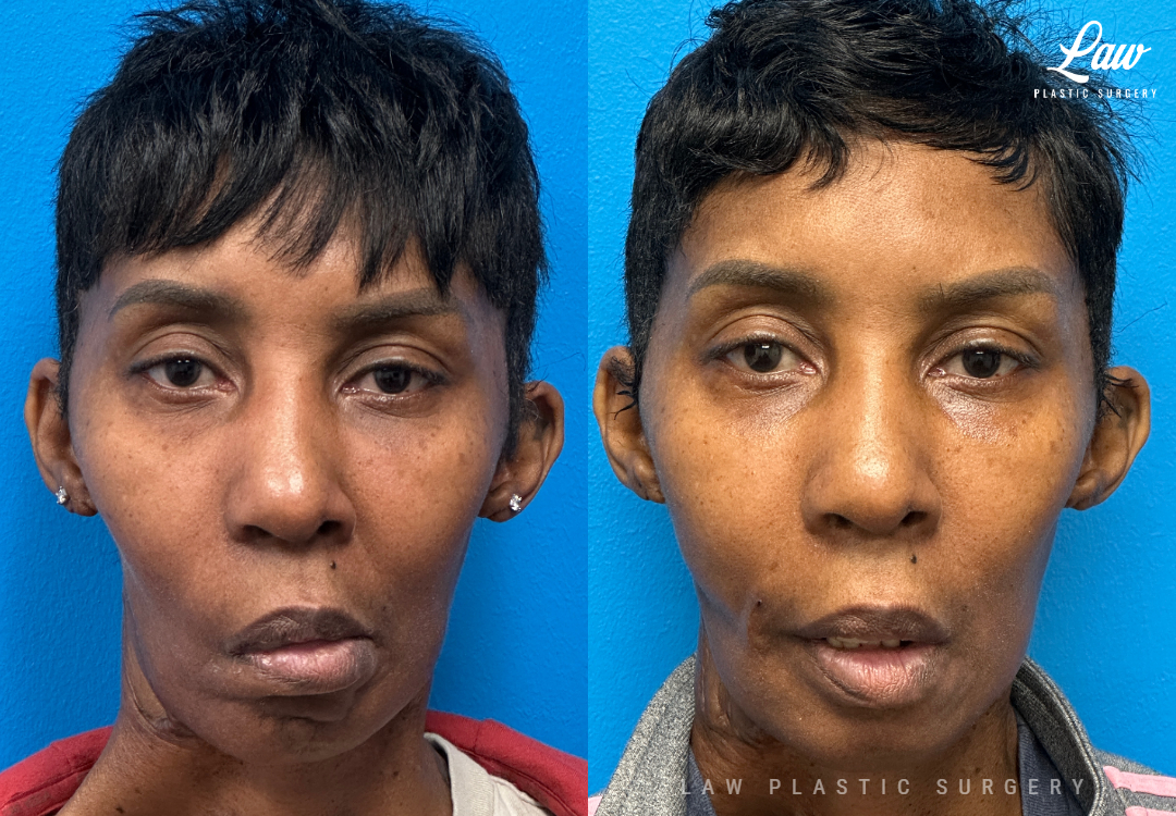 Facial Paralysis Surgery Before & After Photo. Surgery performed in Dallas, TX at Law Plastic Surgery.
