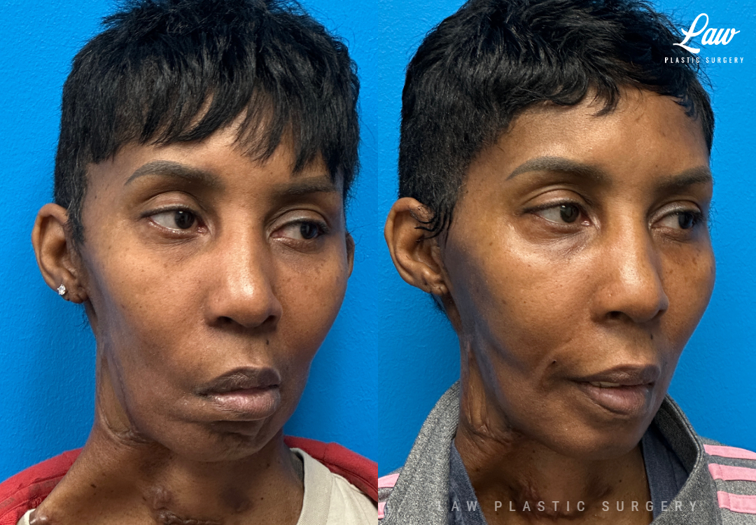 Facial Paralysis Surgery Before & After Photo. Surgery performed in Dallas, TX at Law Plastic Surgery.