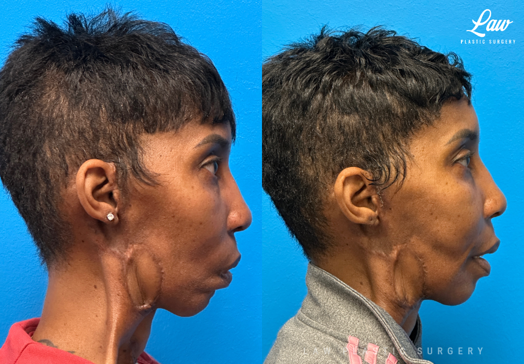 Facial Paralysis Surgery Before & After Photo. Surgery performed in Dallas, TX at Law Plastic Surgery.