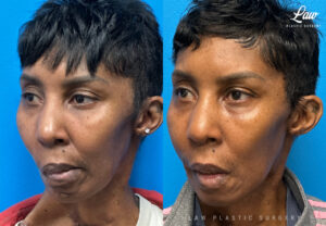 Facial Paralysis Surgery Before & After Photo. Surgery performed in Dallas, TX at Law Plastic Surgery.