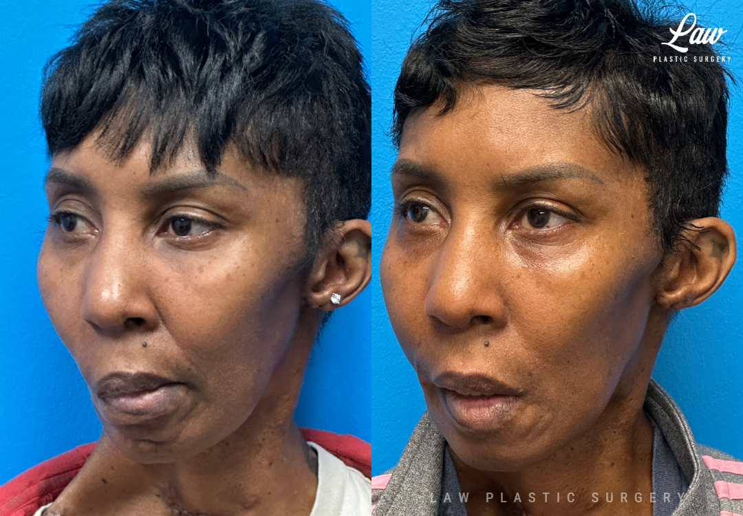 Facial Paralysis Surgery Before & After Photo. Surgery performed in Dallas, TX at Law Plastic Surgery.