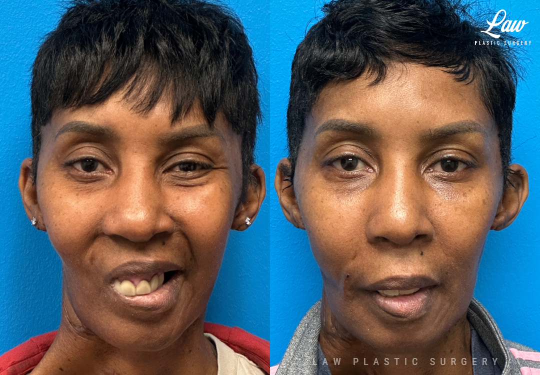 Facial Paralysis Surgery Before & After Photo. Surgery performed in Dallas, TX at Law Plastic Surgery.