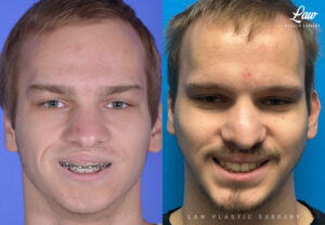 Jaw Surgery Before and After Photo. Surgery performed in Dallas, TX at Law Plastic Surgery.