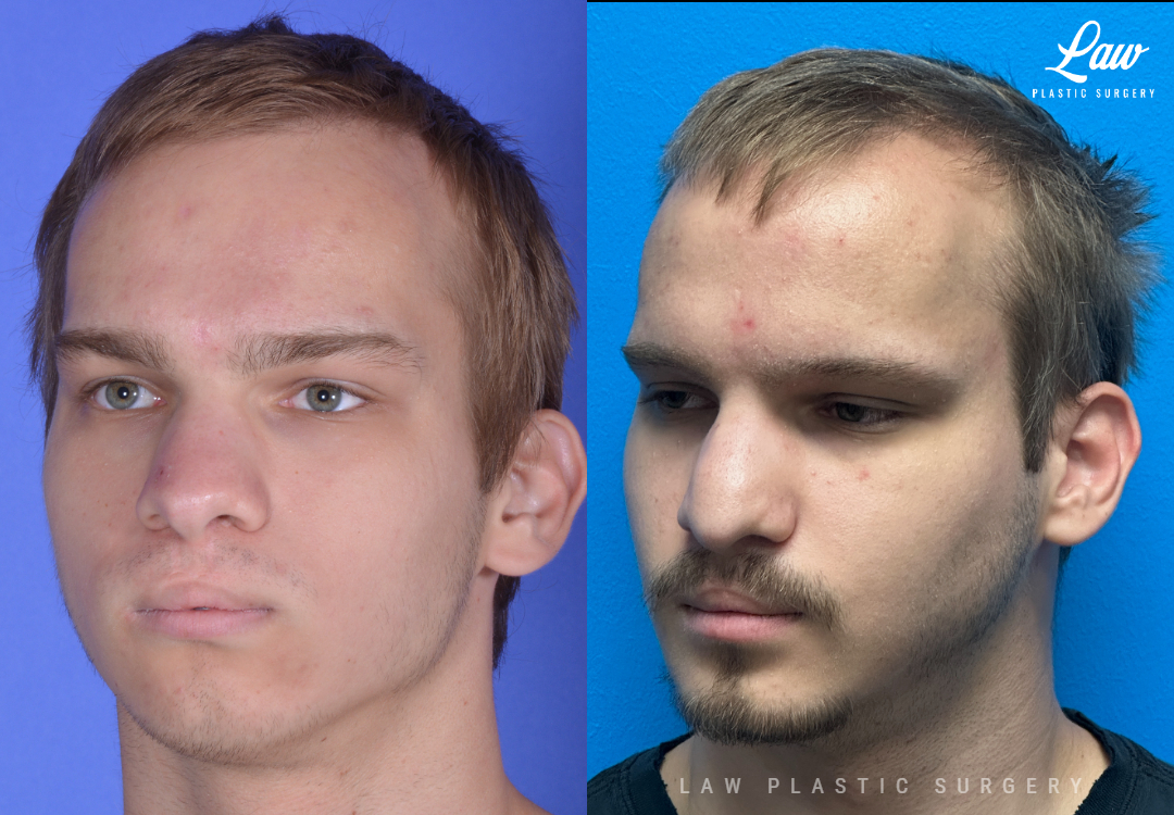 Jaw Surgery Before and After Photo. Surgery performed in Dallas, TX at Law Plastic Surgery.