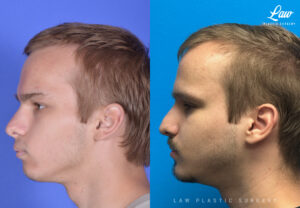 Jaw Surgery Before and After Photo. Surgery performed in Dallas, TX at Law Plastic Surgery.