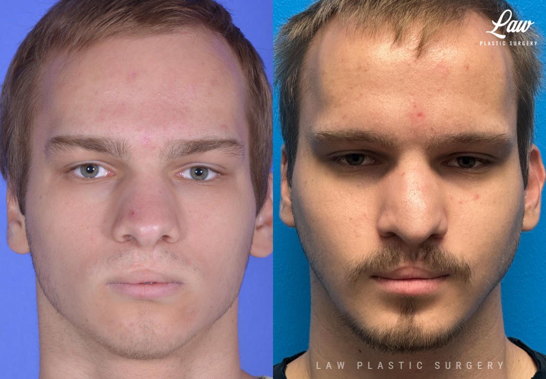 Jaw Surgery Before and After Photo. Surgery performed in Dallas, TX at Law Plastic Surgery.