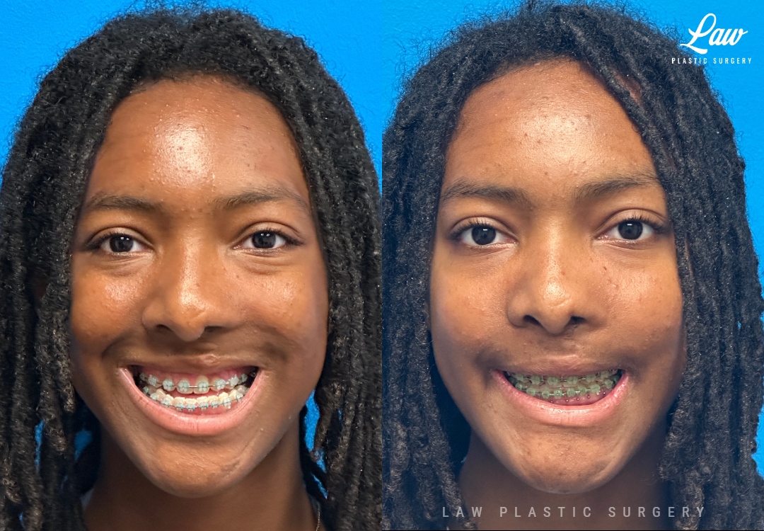 Jaw Surgery Before and After Photo. Surgery performed in Dallas, TX at Law Plastic Surgery.