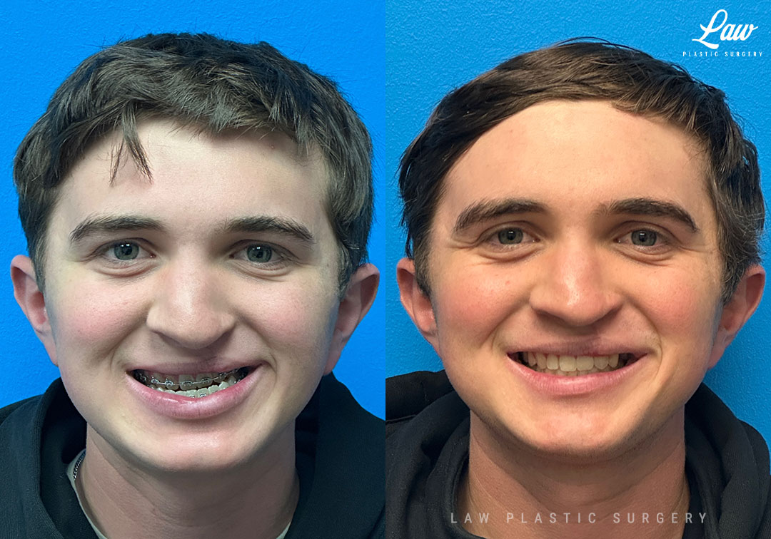 Jaw Surgery Before and After Photo. Surgery performed in Dallas, TX at Law Plastic Surgery.