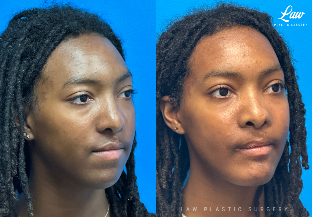 Jaw Surgery Before and After Photo. Surgery performed in Dallas, TX at Law Plastic Surgery.