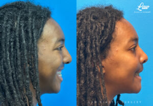 Jaw Surgery Before and After Photo. Surgery performed in Dallas, TX at Law Plastic Surgery.