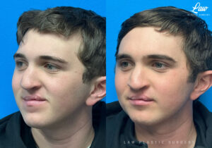 Jaw Surgery Before and After Photo. Surgery performed in Dallas, TX at Law Plastic Surgery.