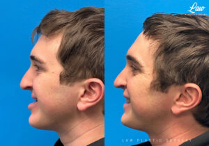 Jaw Surgery Before and After Photo. Surgery performed in Dallas, TX at Law Plastic Surgery.
