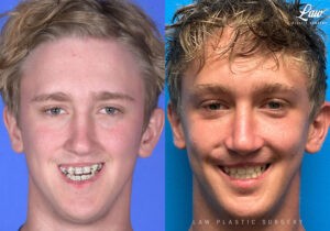 Jaw Surgery Before and After Photo. Surgery performed in Dallas, TX at Law Plastic Surgery.