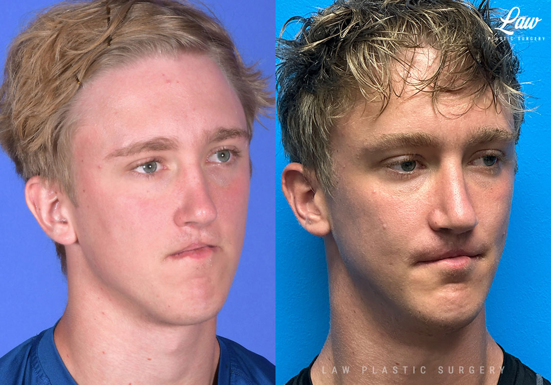 Jaw Surgery Before and After Photo. Surgery performed in Dallas, TX at Law Plastic Surgery.